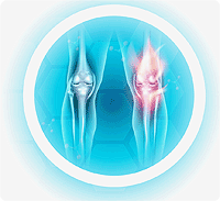 arthritis of the knee